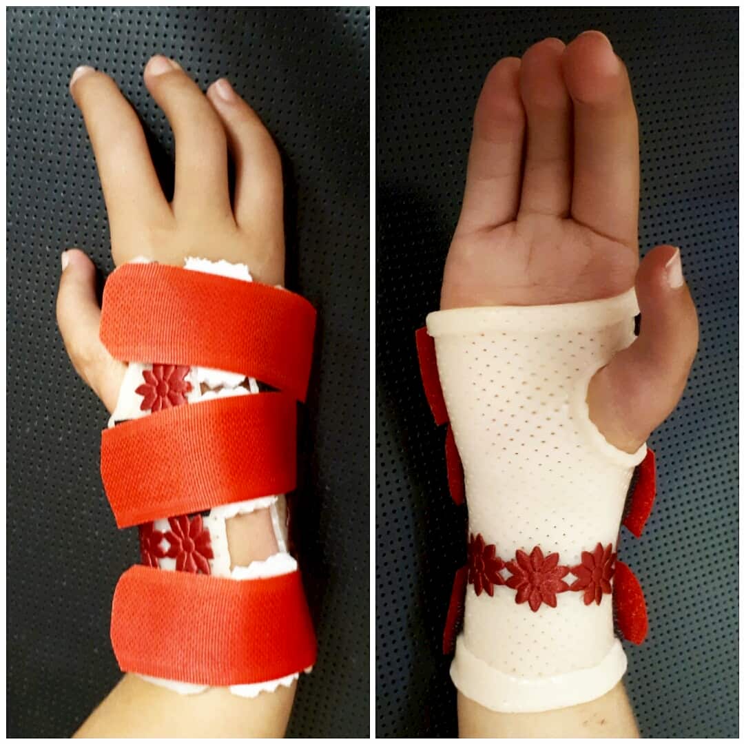 Orthosis for clubhand.