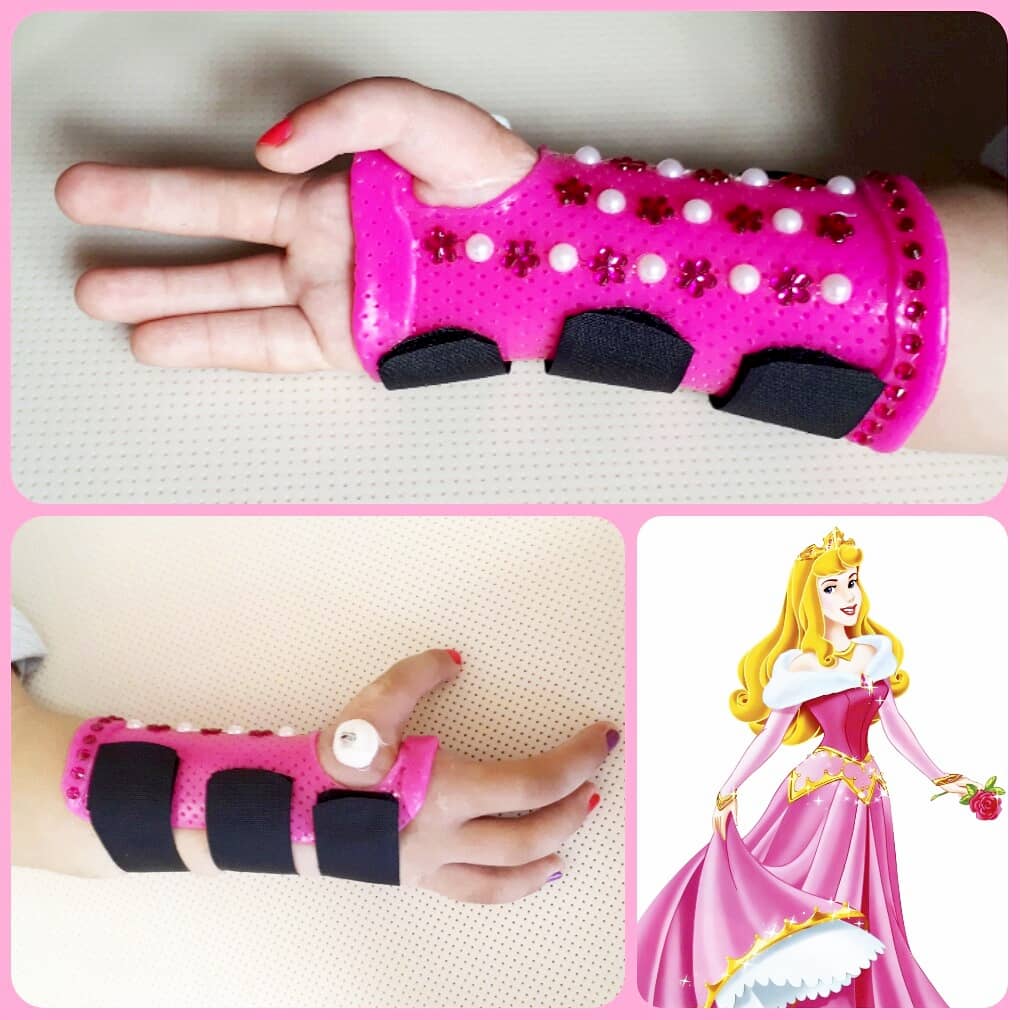 Orthotic fabrication for congenital malformation of clubhand