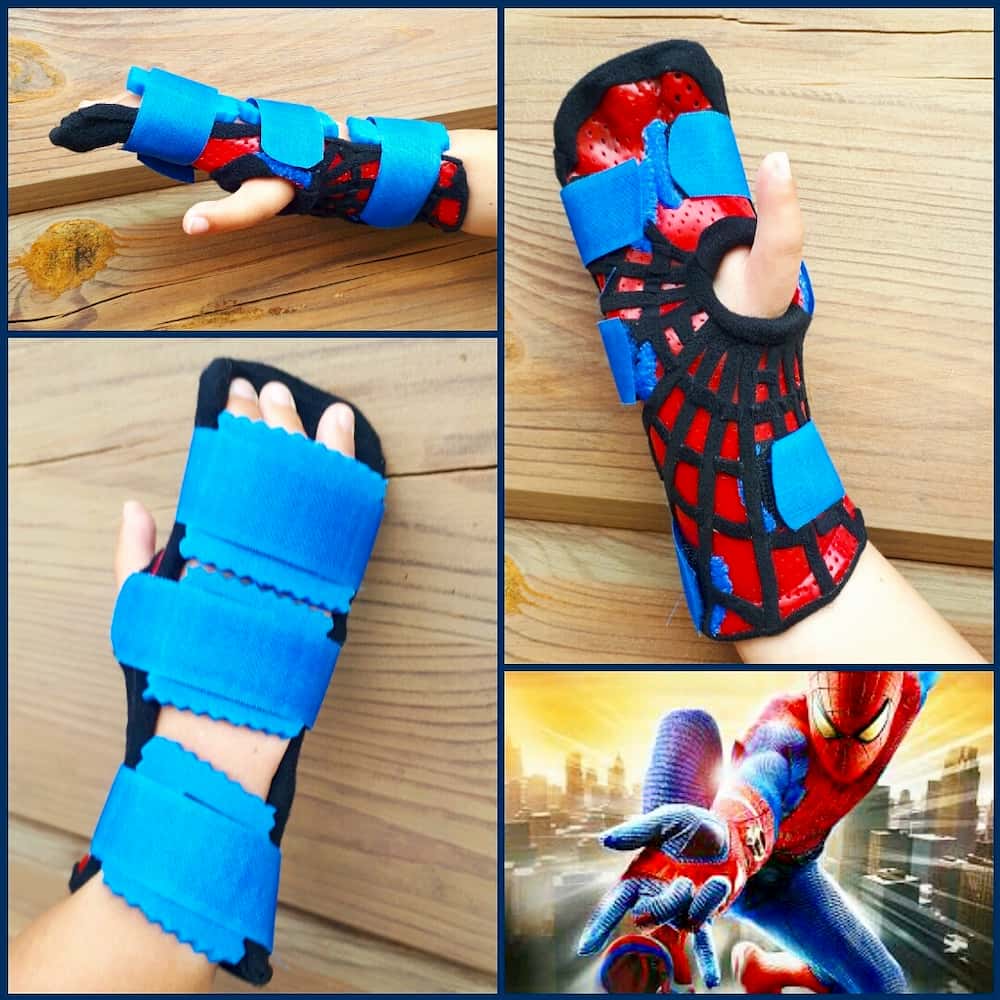 Orthosis for clubhand congenital malformation.