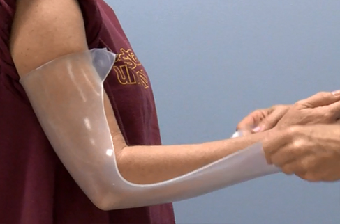 Molding thermoplastic material on a patient's arm