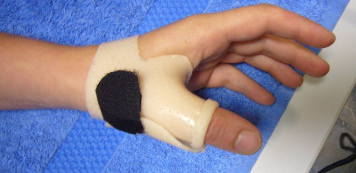 splint-in-the-spotlight-short-thumb-spica-opponens-splint-orfit