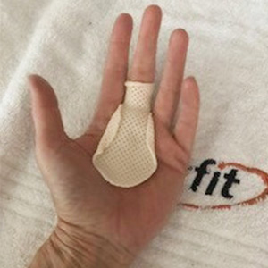 Fabrication of an MCP joint blocking orthosis for trigger finger