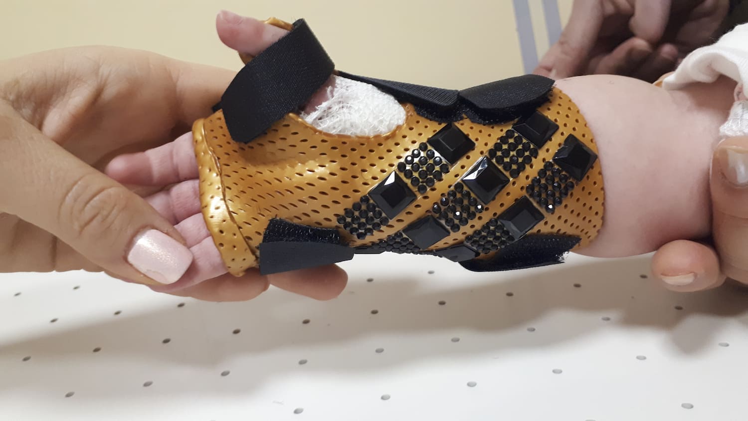 Orthosis for the congenital malformation Triphalangeal thumb