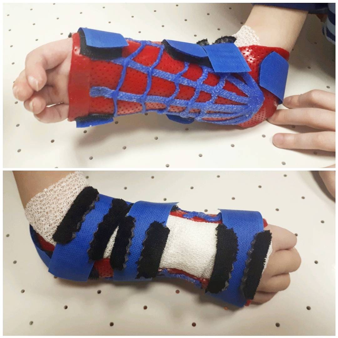 orthosis for congenital malformation following radialization