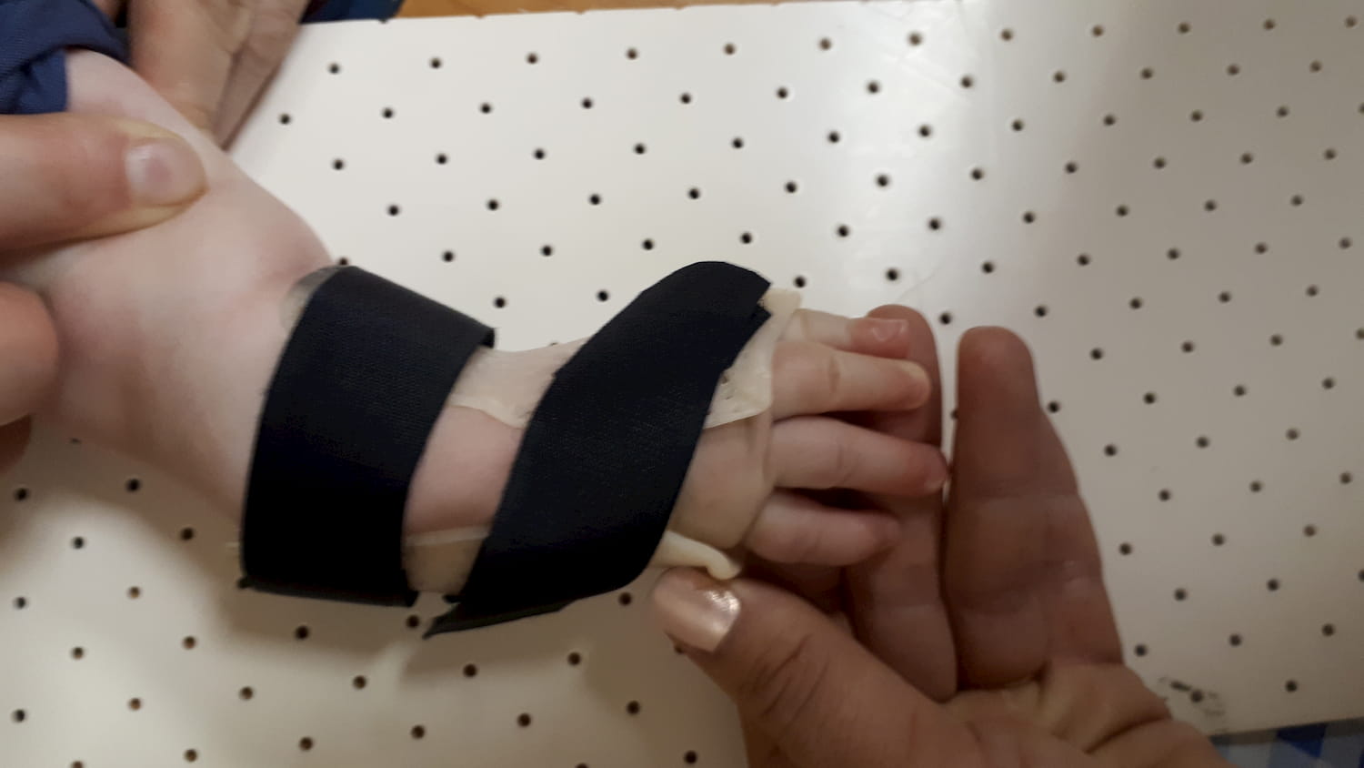 Orthosis for clubhand